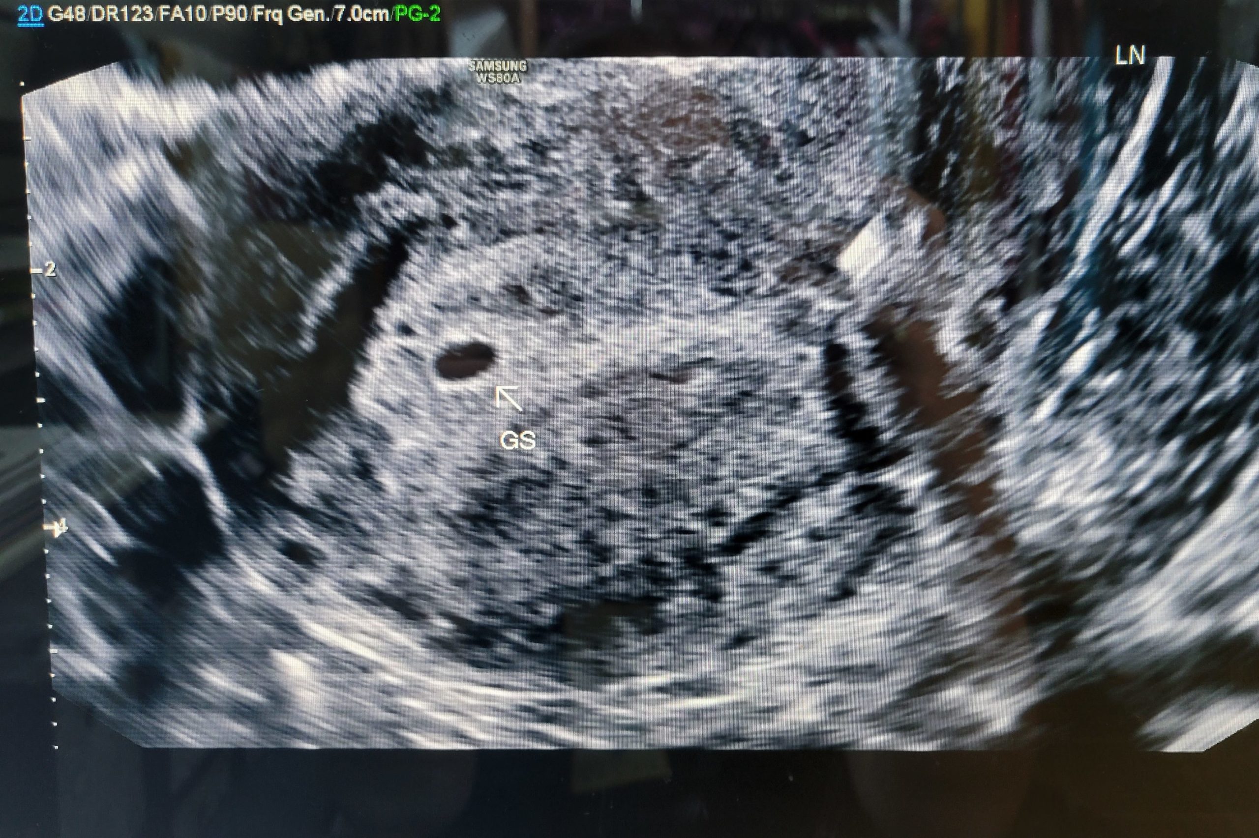 ultrasound of confirmed gestational sac at 5 weeks pregnant