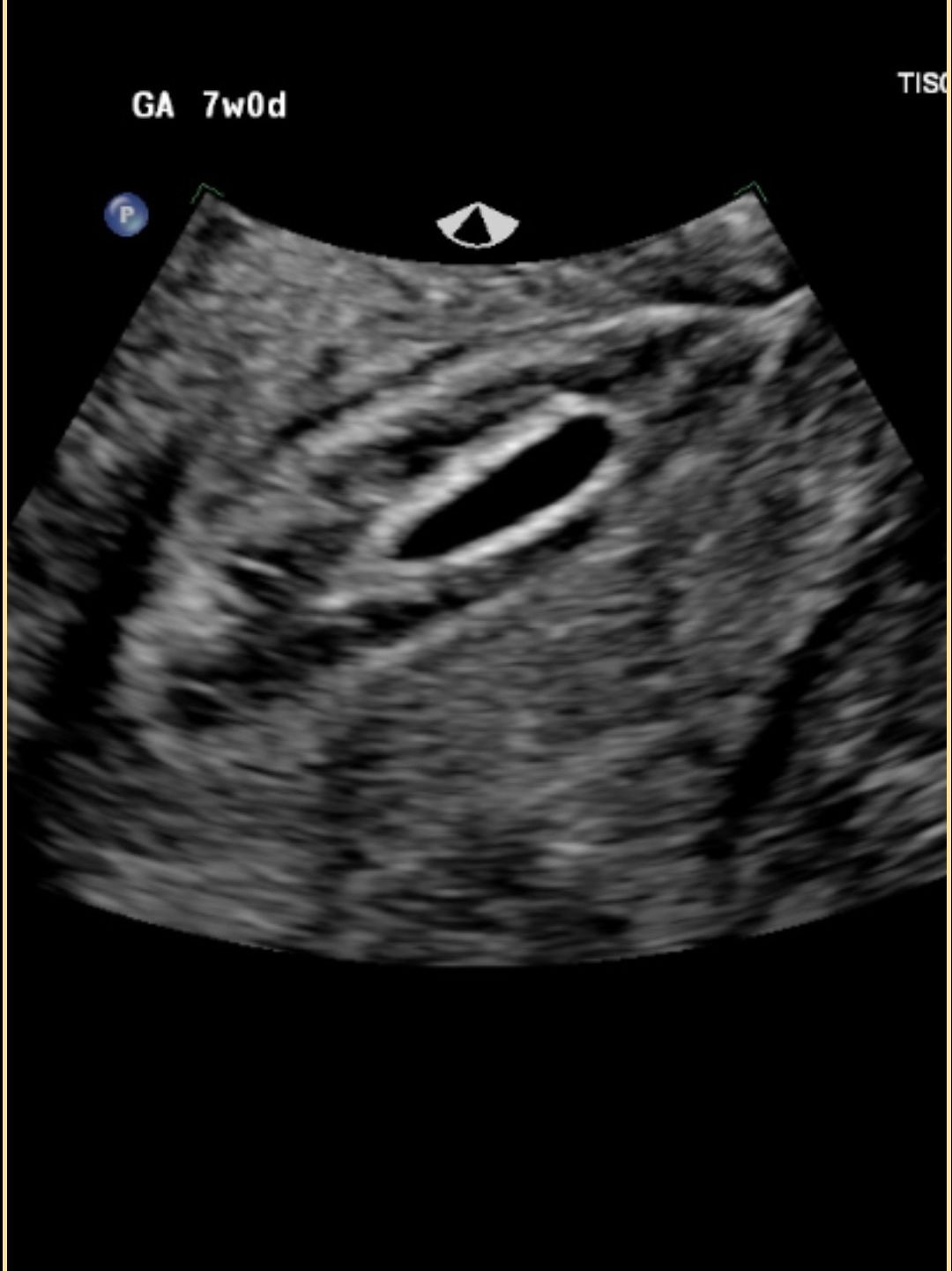 Empty gestational sac at 7 weeks pregnant. Blighted ovum ultrasound. Missed miscarriage ultrasound at 7 weeks. 