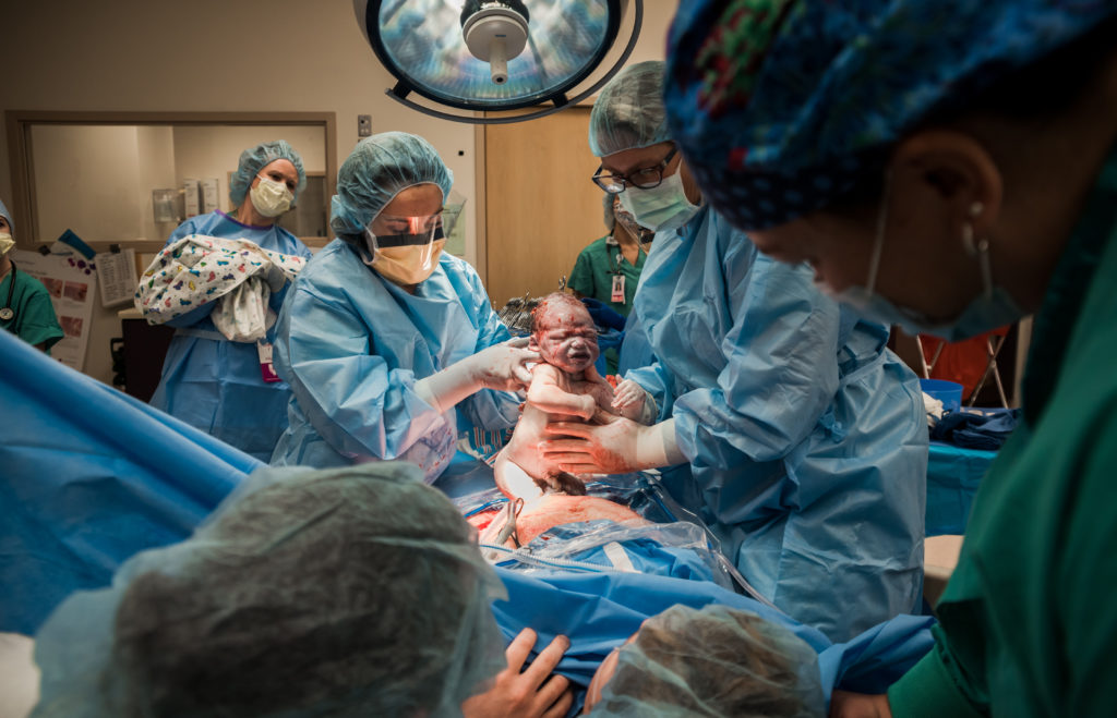 Nurses and midwives lifting baby out of mom's belly during a cesarean at Avista hospital in Colorado.