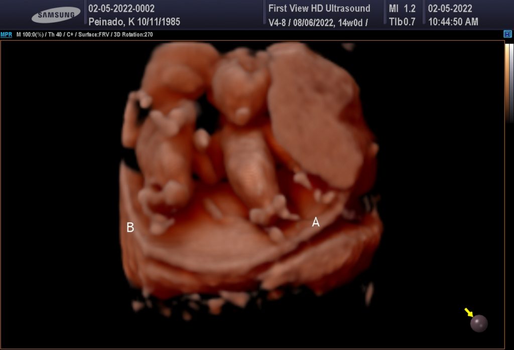 3D fraternal twin ultrasound photo