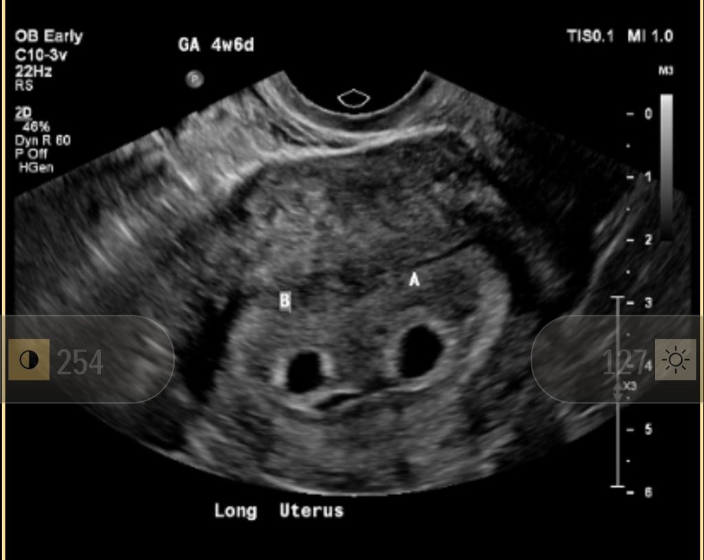 5 week twin ultrasound photo. Twin A twin B two sacs. Di-amniotic Di-chorionic twins