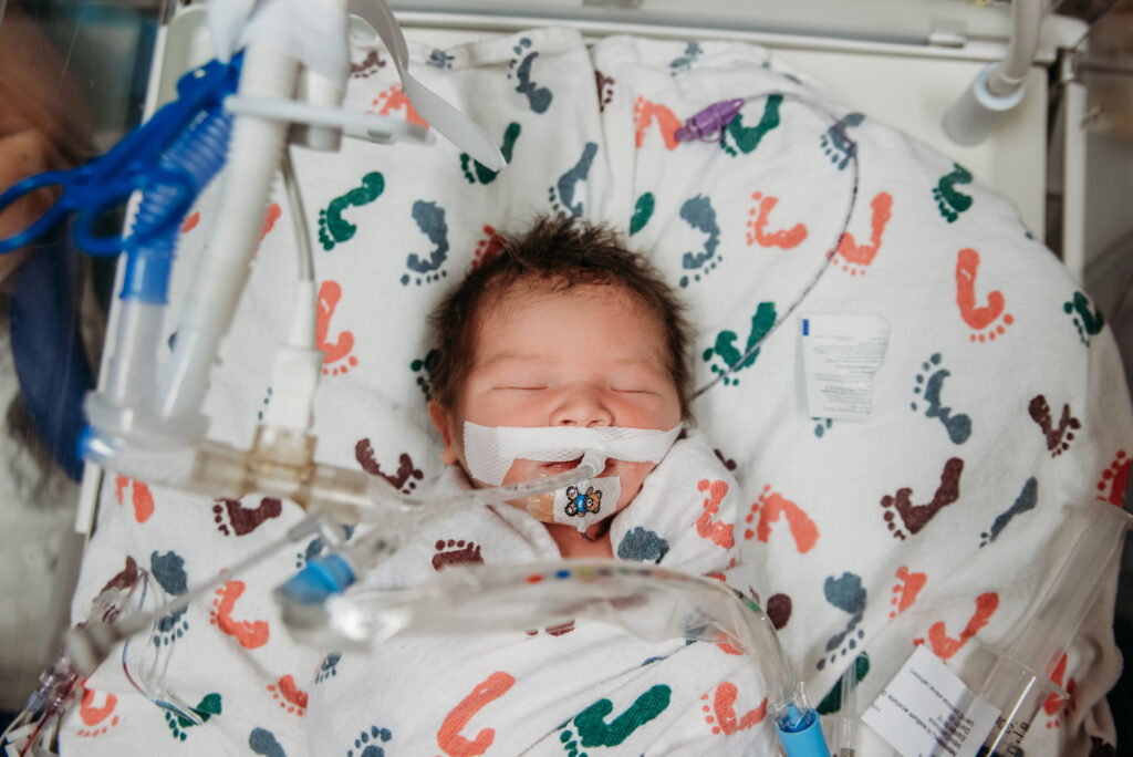 Baby with a lot of hair in the NICU with tubes connected to him.